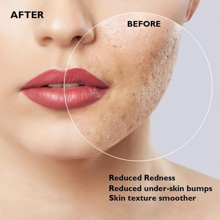 CICA Calming Blemish Clearing Face Wash 100ml | 1.5% Salicylic Acid Cleanser | Anti-Acne Face Wash for Oil Control, Blackhead Removal & Clear Skin
